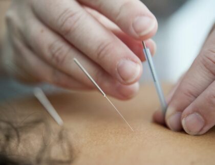 Calgary Acupuncture