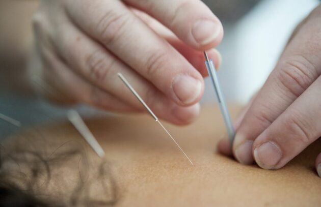 Calgary Acupuncture